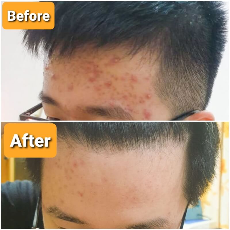 Pemakaian 2x sehari setelah 3-4 minggu.